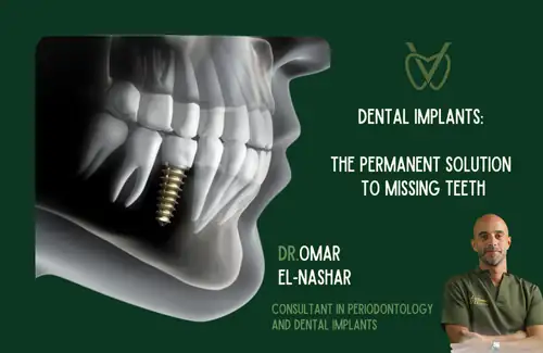Dental Implants: The Permanent Solution to Missing Teeth