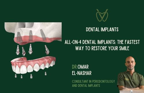 All-on-4 Dental Implants: The Fastest Way to Restore Your Smile in Egypt